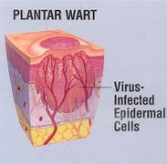 Image result for Wart Root Diagram