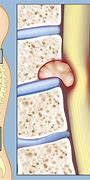 Image result for Tumor On Spinal Cord