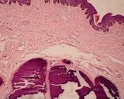 Image result for calcicosis