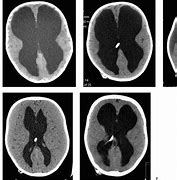 Image result for Acquired Hydrocephalus