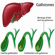 Image result for Gallbladder with Gallstones
