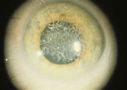 Image result for Macular Dystrophy Cornea