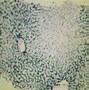 Image result for hemocromayosis
