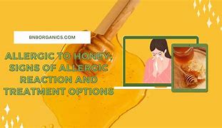 Image result for Honey Allergy Symptoms