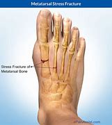 Image result for 5th Metatarsal Stress Fracture