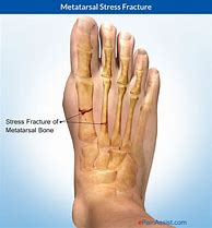 Image result for Displaced Metatarsal Fracture