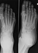 Image result for OS Peroneum Fracture Treatment