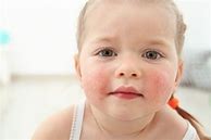 Image result for Baby Food Allergy