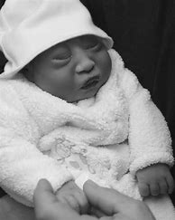 Image result for Anencephalic Babies