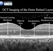 Image result for Inner Retina Oct