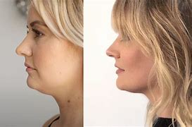 Image result for CoolSculpting Chin Before and After
