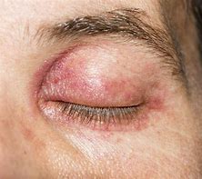 Image result for Itchy Rash On Eyelids