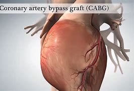 Image result for Exterior Open Heart Bypass Surgery