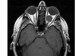 Image result for Brain Tumor Behind Eye
