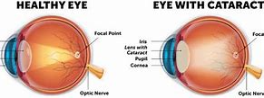 Image result for Diagram of a Cataract