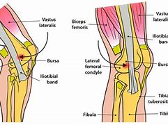 Image result for ITB Knee Pain Treatment