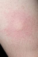 Image result for Allergic Reaction to Bug Bite