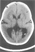 Image result for Lissencephaly CT Scan