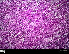 Image result for Fibroid Images