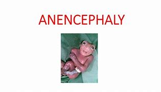 Image result for Acrania vs Anencephaly