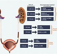 Image result for Left Kidney Stone