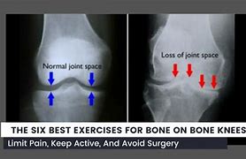 Image result for Bone On Bone Knee Exercises