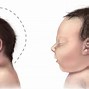 Image result for Microcephaly Skull