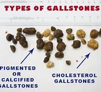 Image result for GallStone Size