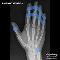 Image result for Psoriatic Arthritis Hands XR