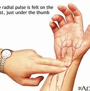Image result for Radial Artery Pulse