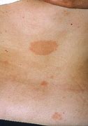Image result for Pityriasis Rosea