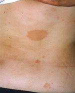 Image result for Pityriasis Rosea in Skin of Color