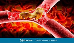 Image result for arterioesclerosis