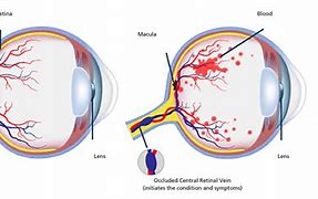 Image result for Central Retinal Vein Occlusion