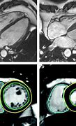 Image result for MRI Imaging Myocardial Infarction