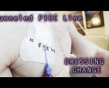Image result for Bard Tunneled PICC
