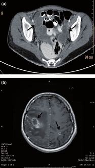 Image result for Adnexal Cyst CT