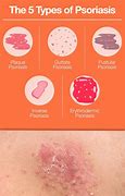 Image result for Psoriasis