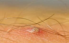 Image result for Ingrown Hair Blood Blister