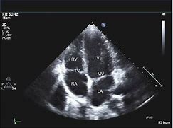 Image result for Echo Heart Ultrasound