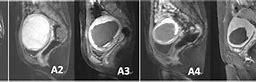 Image result for 6 Cm Fibroids in Uterus