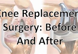 Image result for Orthopedic Knee Surgery