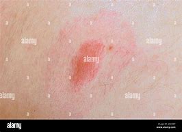 Image result for Target-Shaped Lesion