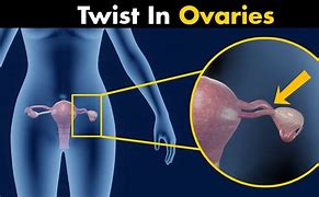 Image result for Ovarian Torsion
