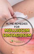 Image result for Molluscum Treatment Natural Face