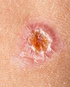 Image result for What Does an Infected Sore Look Like