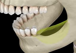 Image result for Tooth Bone Loss