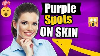 Image result for What Is Warts On Skin