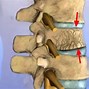 Image result for Lumbar Compression Fracture Back Brace