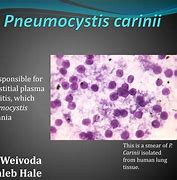 Image result for pneumocystis_carinii